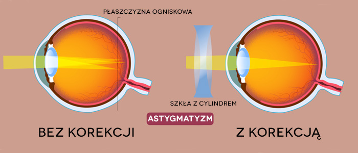schemat gałki ocznej z astygmatyzmem i po korekcji cylindrami